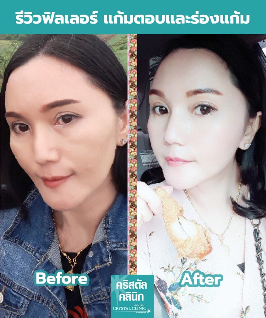 ฟิลเลอร์แก้มตอบและร่องแก้ม คริสตัลคลินิก มหาสารคาม