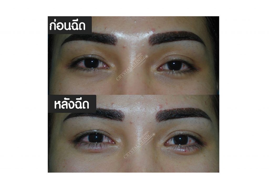 Filler ฟิลเลอร์ดอลลี่อาย คริสตัลคลินิก มหาสารคาม