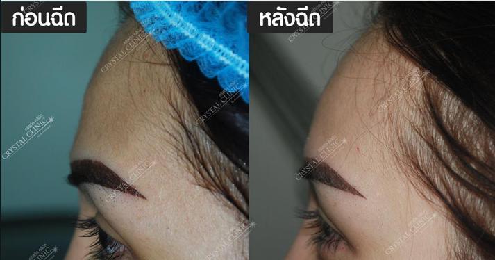 Filler ฟิลเลอร์หน้าผาก คริสตัลคลินิก มหาสารคาม Filler ฟิลเลอร์หน้าผาก คริสตัลคลินิก มหาสารคาม