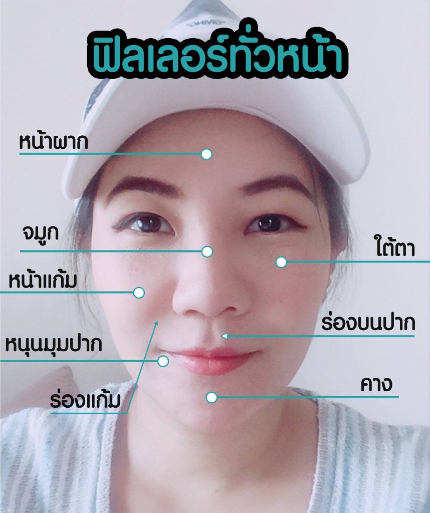 Filler ฟิลเลอร์ทั่วหน้า คริสตัลคลินิก มหาสารคาม