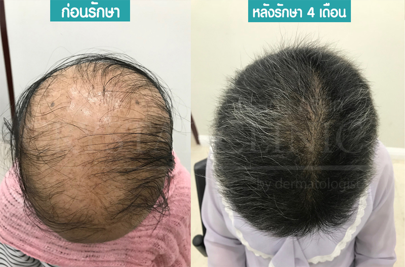 รักษาผมร่วง ผมบาง ปลูกผม คริสตัลคลินิก มหาสารคาม รักษาผมร่วง ผมบาง ปลูกผม คริสตัลคลินิก มหาสารคาม