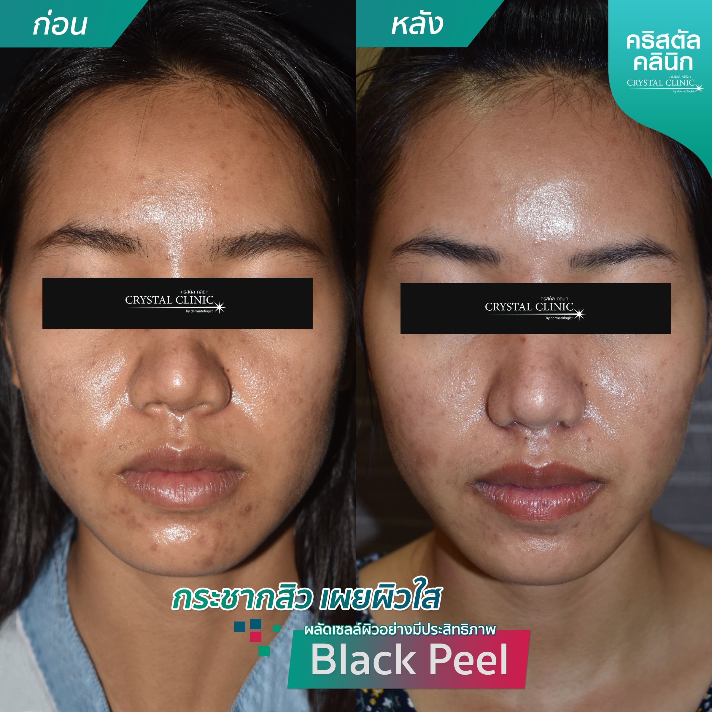 รีวิวการผลัดเซลล์ผิวอย่างมีประสิทธิภาพ -ลบรอยสิว-ปรับผิวขาว-MPeel รีวิวการผลัดเซลล์ผิวอย่างมีประสิทธิภาพ-กระชากสิว-เผยสิวใส-ฺBlackPeel