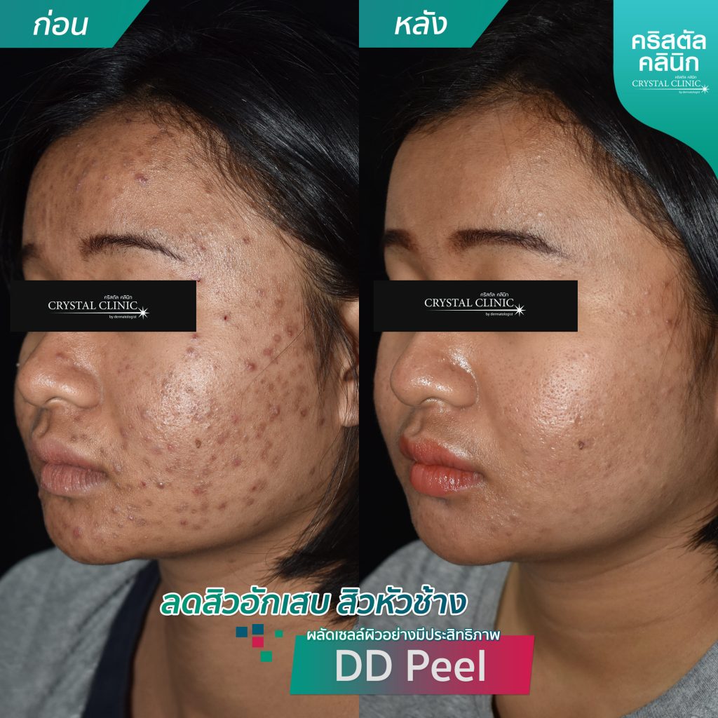 รีวิวการผลัดเซลล์ผิวอย่างมีประสิทธิภาพ DD Peel รีวิวการผลัดเซลล์ผิวอย่างมีประสิทธิภาพ -ลดสิวอักเสบ-สิวหัวช้าง-DDPeel
