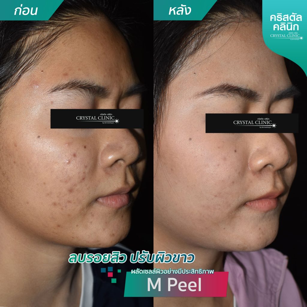 รีวิวการผลัดเซลล์ผิวอย่างมีประสิทธิภาพ -ลบรอยสิว-ปรับผิวขาว-MPeel รีวิวการผลัดเซลล์ผิวอย่างมีประสิทธิภาพ -ลบรอยสิว-ปรับผิวขาว-MPeel