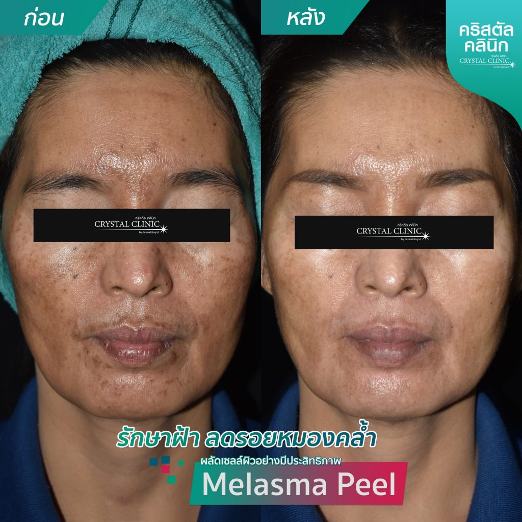 รีวิวการผลัดเซลล์ผิวอย่างมีประสิทธิภาพ -รักษาฝ้า-ลดรอยหมองคล้ำ-MelasmaPeel รีวิวการผลัดเซลล์ผิวอย่างมีประสิทธิภาพ -รักษาฝ้า-ลดรอยหมองคล้ำ-MelasmaPeel