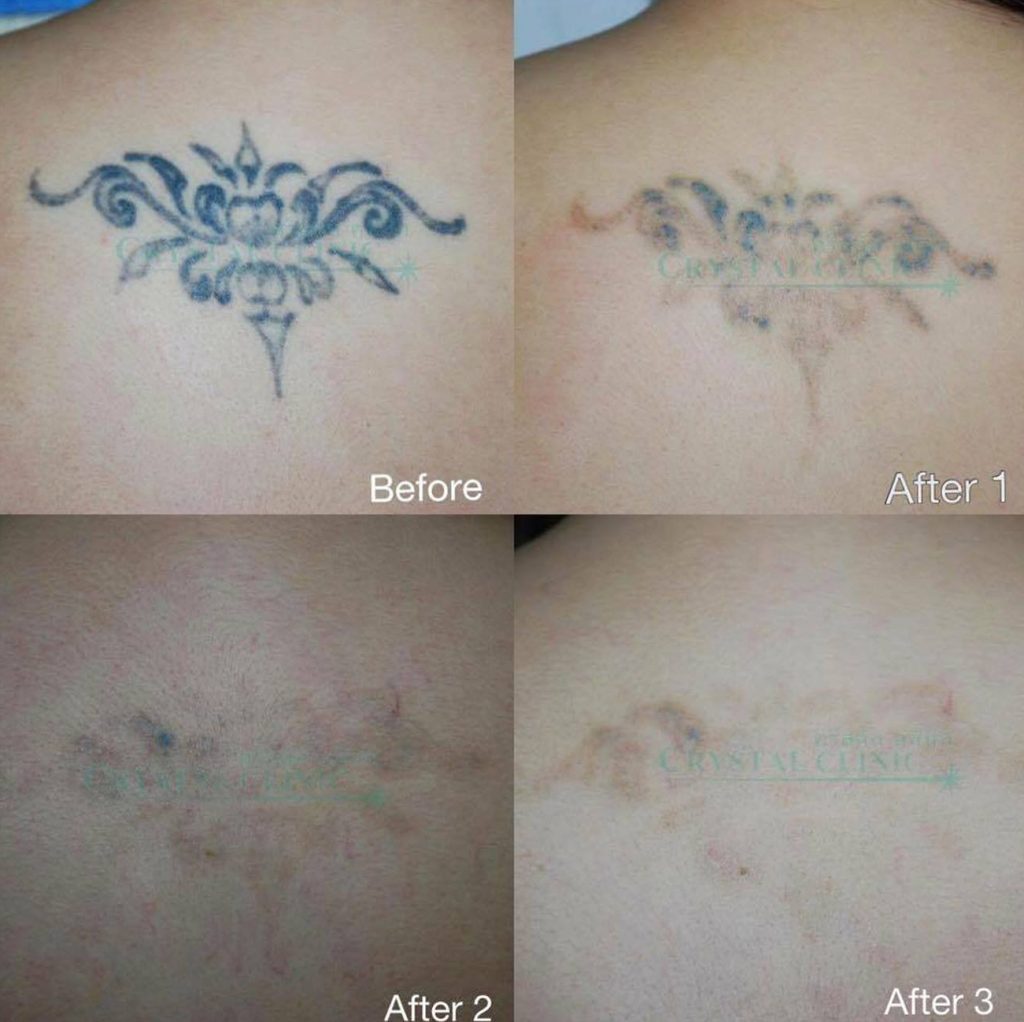 เคสรีวิวลบรอยสักด้วยเลเซอร์ Q-Switch Nd YAG Laser คริสตัลคลินิก มหาสารคาม เลเซอร์รักษารอยสัก คริสตัลคลินิก มหาสารคาม