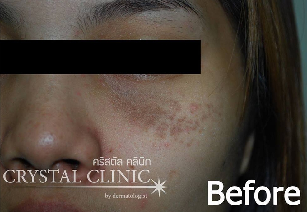 เลเซอร์รักษาปานดำ spectra gold คริสตัลคลินิก มหาสารคาม เลเซอร์รักษาปานดำ spectra gold คริสตัลคลินิก มหาสารคาม