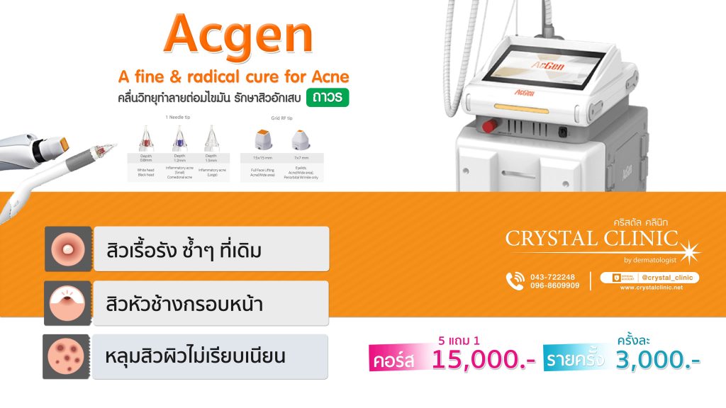 รักษาสิวอักเสบด้วยคลื่นวิทยุ Acgen-Radiofrequency คริสตัลคลินิก มหาสารคาม รักษาสิวอักเสบด้วยคลื่นวิทยุ Acgen-Radiofrequency คริสตัลคลินิก มหาสารคาม