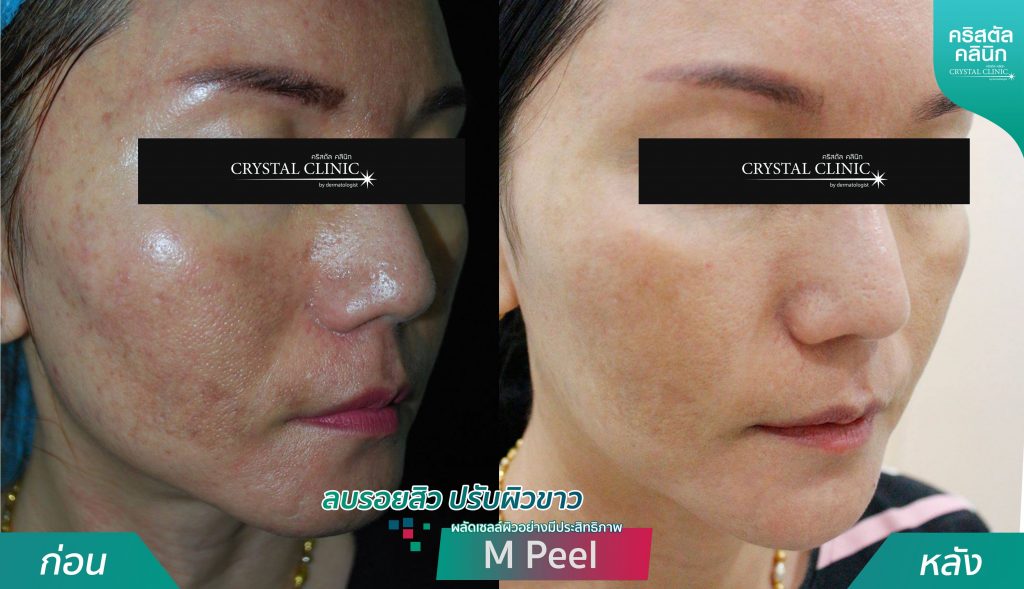 รีวิวการผลัดเซลล์ผิวอย่างมีประสิทธิภาพ -ลบรอยสิว-ปรับผิวขาว-MPeel