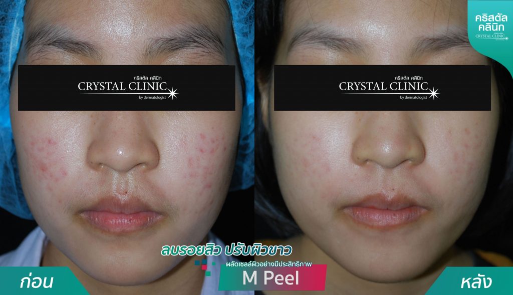 รีวิวการผลัดเซลล์ผิวอย่างมีประสิทธิภาพ -ลบรอยสิว-ปรับผิวขาว-MPeel รีวิวการผลัดเซลล์ผิวอย่างมีประสิทธิภาพ -ลบรอยสิว-ปรับผิวขาว-MPeel