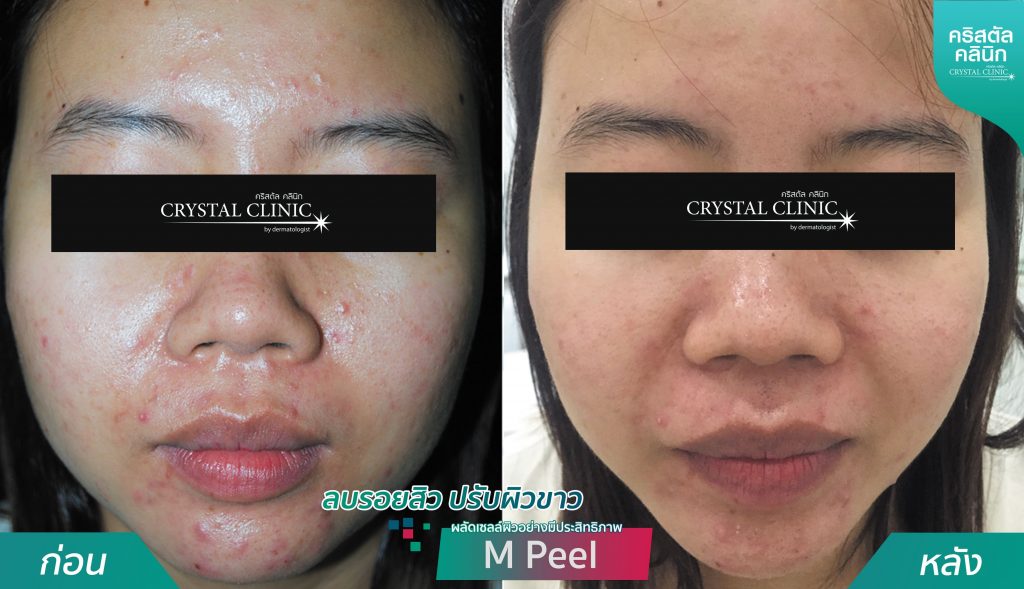 รีวิวการผลัดเซลล์ผิวอย่างมีประสิทธิภาพ -ลบรอยสิว-ปรับผิวขาว-MPeel รีวิวการผลัดเซลล์ผิวอย่างมีประสิทธิภาพ -ลบรอยสิว-ปรับผิวขาว-MPeel