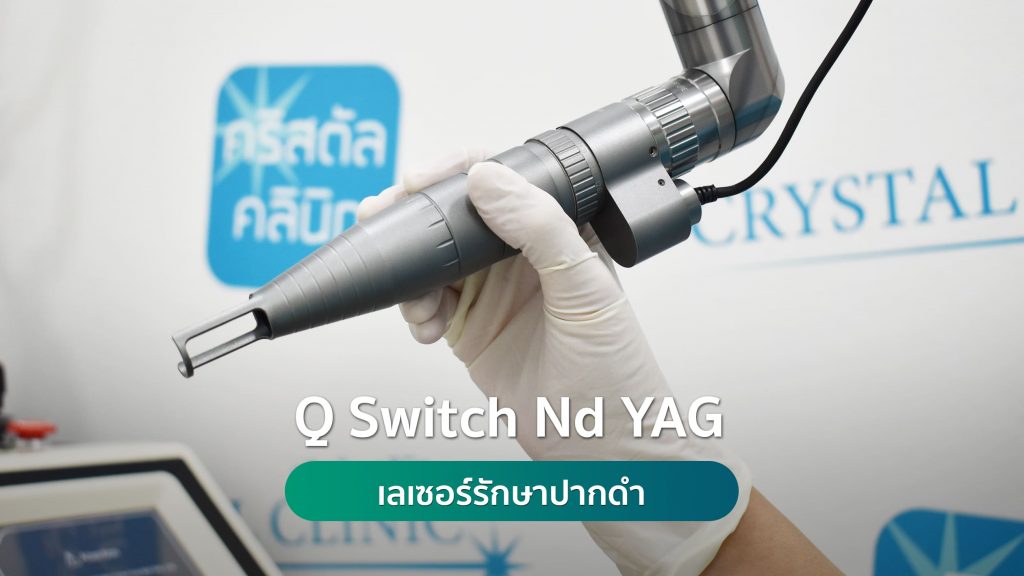 Qs Nd YAG Laser เลเซอร์รักษาปากดำ คริสตัลคลินิก มหาสารคาม