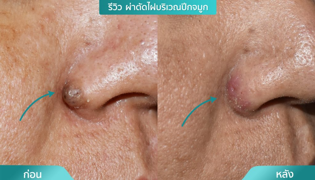 ผ่าตัดไฝ ชิ้นเนื้อ เนื้องอกชนิดต่างๆ คริสตัลคลินิก มหาสารคาม