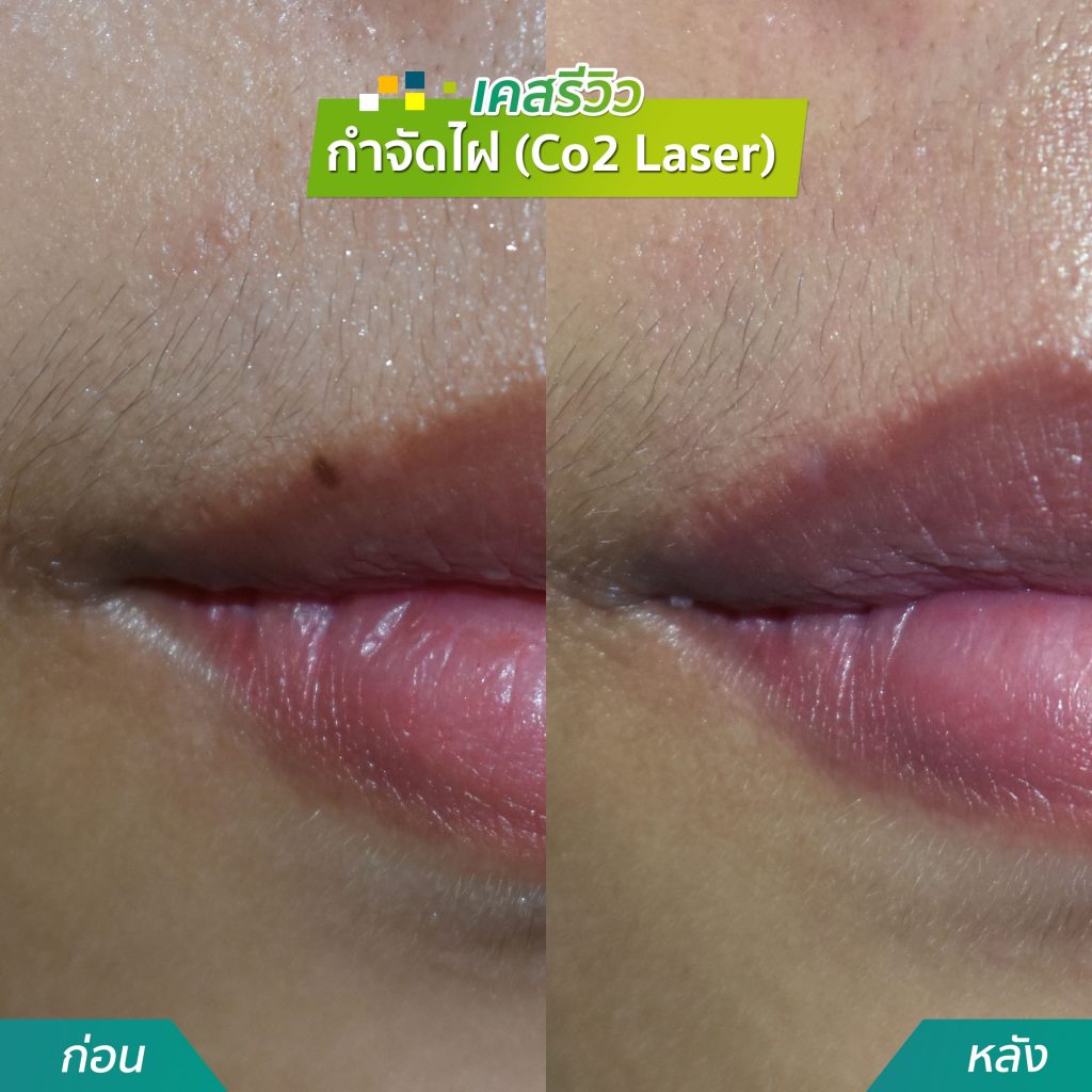 กำจัดไฝ Co2 Laser คริสตัลคลินิก มหาสารคาม กำจัดไฝ Co2 Laser คริสตัลคลินิก มหาสารคาม