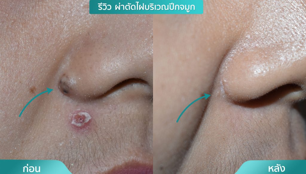 ผ่าตัดไฝ ชิ้นเนื้อ เนื้องอกชนิดต่างๆ คริสตัลคลินิก มหาสารคาม