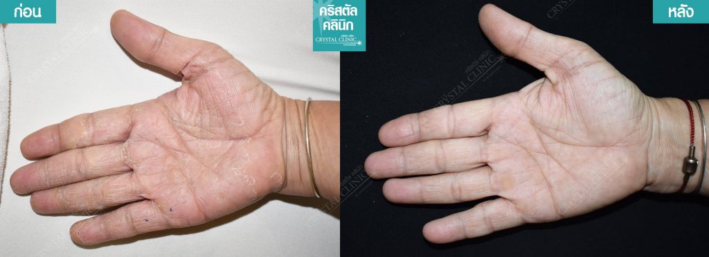 เชื้อกลากที่ฝ่ามือ เชื้อกลากที่ฝ่ามือ