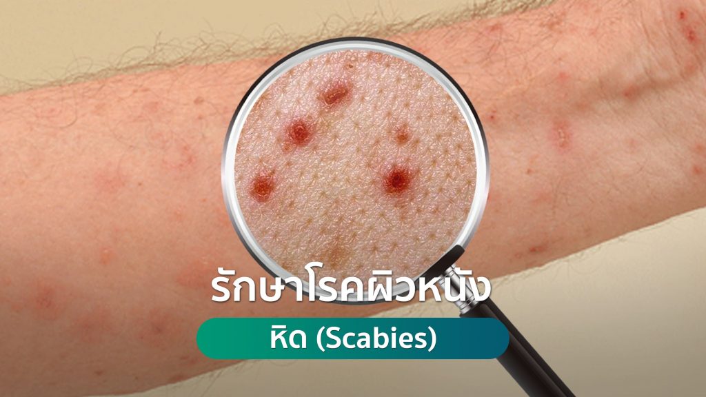 รักษาโรคผิวหนัง รักษาหิด (Scabies)