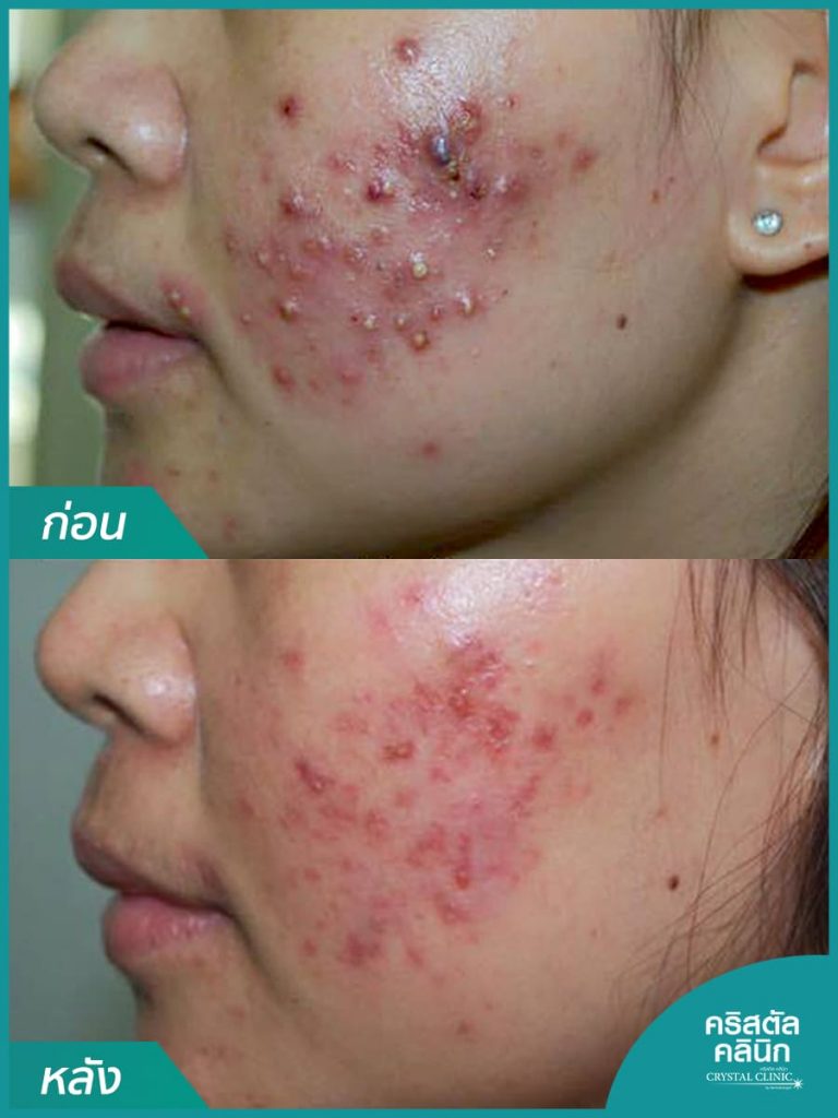 รูปรีวิวการรักษาสิว คริสตัลคลินิก มหาสารคาม รูปรีวิวการรักษาสิว คริสตัลคลินิก มหาสารคาม