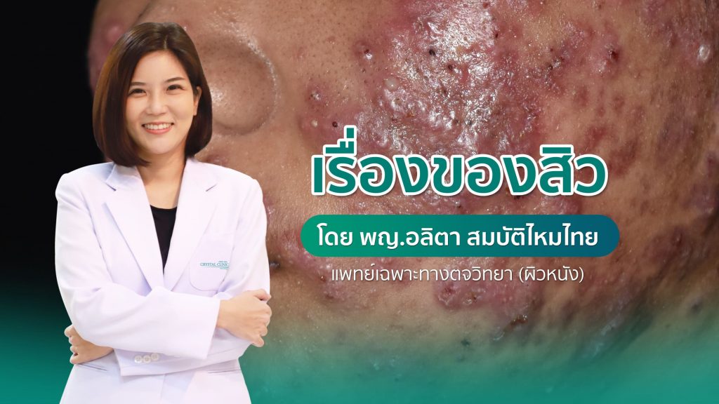 บทความเรื่องสิวเกิดจากอะไร วิธีการรักษาสิว โดย พญ.อลิตา สมบัติไหมไทย แพทย์เฉพาะทางผิวหนัง ประจำคริสตัลคลินิก มหาสารคาม