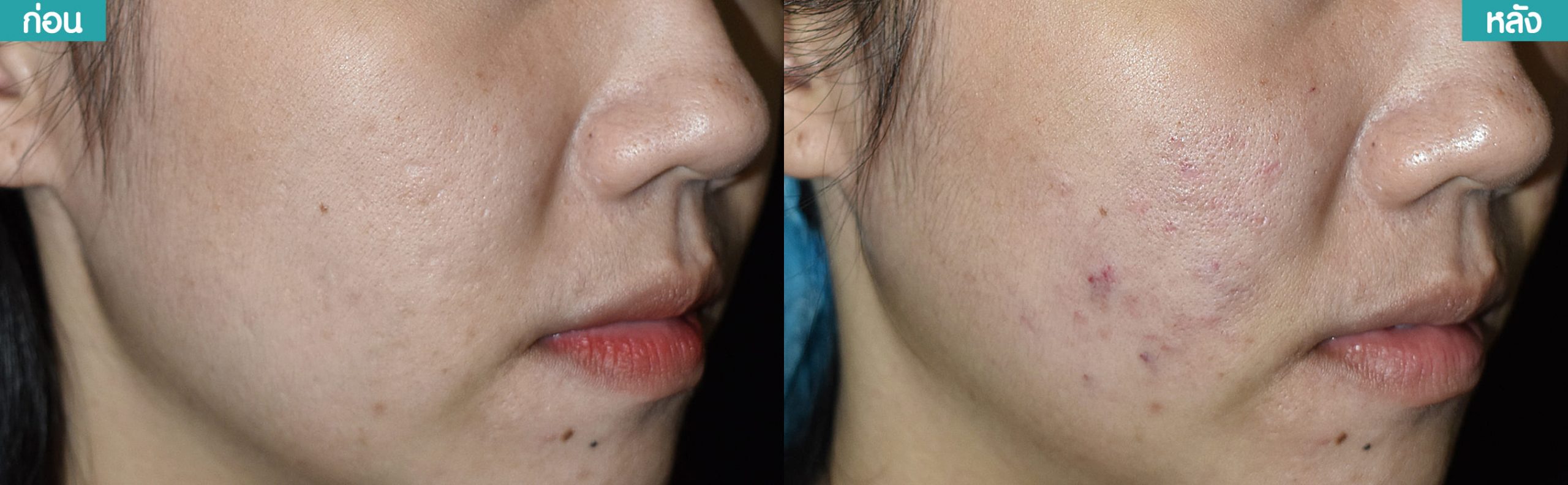รีวิว เติมเต็มหลุมสิวด้วยฟิลเลอร์ (Skin Booster) คริสตัลคลินิก มหาสารคาม รีวิว เติมเต็มหลุมสิวด้วยฟิลเลอร์ (Skin Booster) คริสตัลคลินิก มหาสารคาม