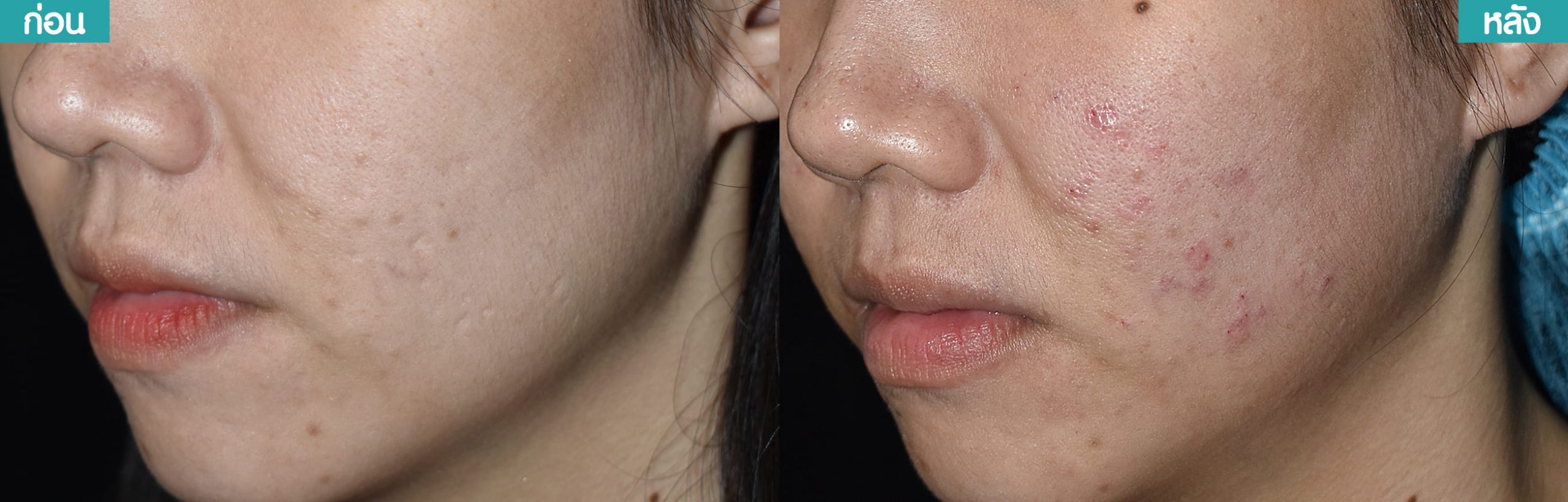 รีวิว เติมเต็มหลุมสิวด้วยฟิลเลอร์ (Skin Booster) คริสตัลคลินิก มหาสารคาม รีวิว เติมเต็มหลุมสิวด้วยฟิลเลอร์ (Skin Booster) คริสตัลคลินิก มหาสารคาม