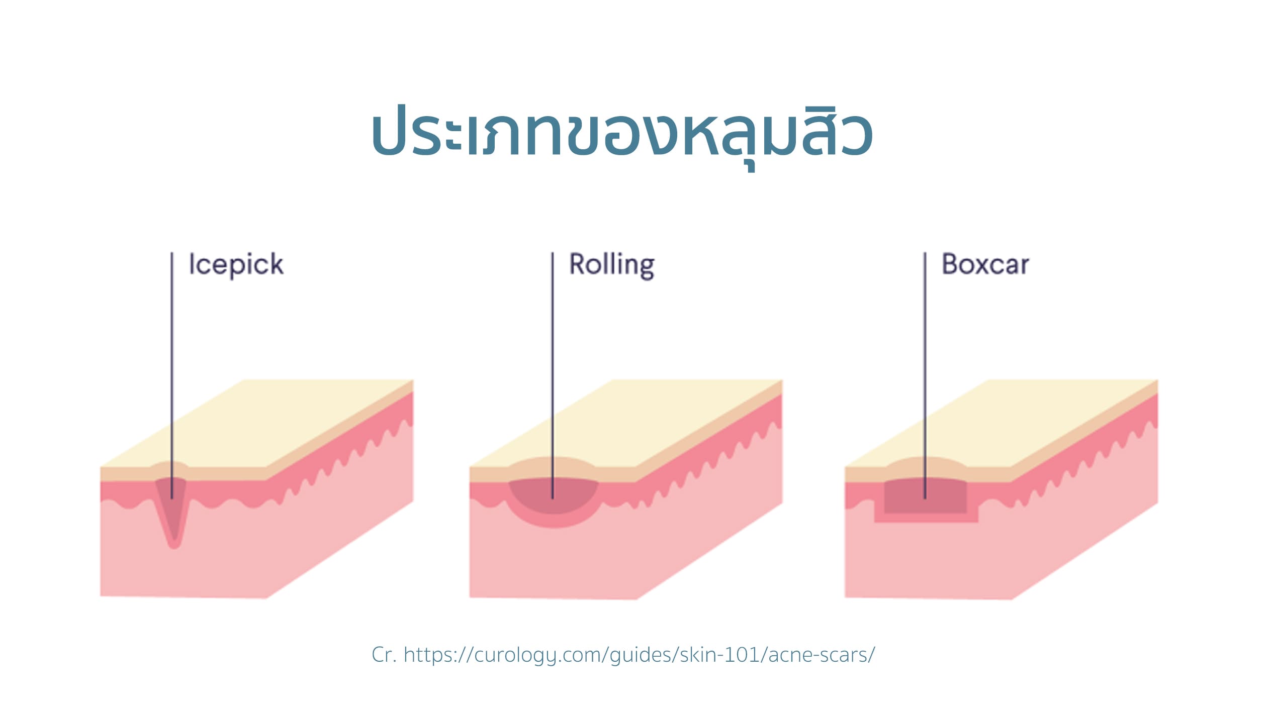 ประเภทของหลุมสิว หลุมสิวมีกี่ประเภท ประเภทของหลุมสิว หลุมสิวมีกี่ประเภท