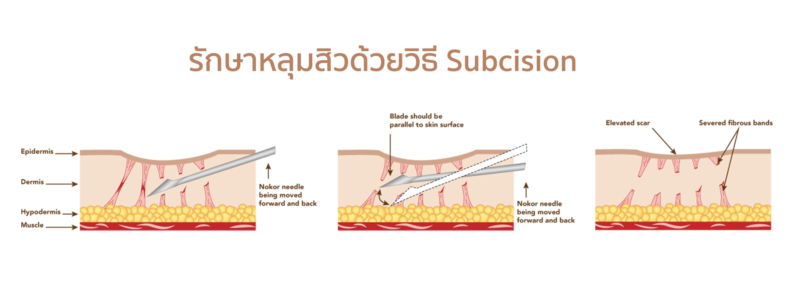 ขั้นตอนการรักษาหลุมสิวด้วยวิธี Subcision ขั้นตอนการรักษาหลุมสิวด้วยวิธี Subcision