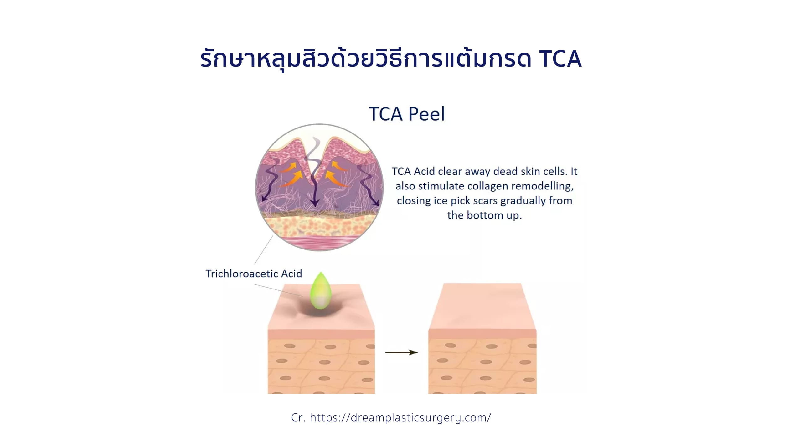 รักษาหลุมสิวด้วยวิธีการแต้มกรด TCA รักษาหลุมสิวด้วยวิธีการแต้มกรด TCA