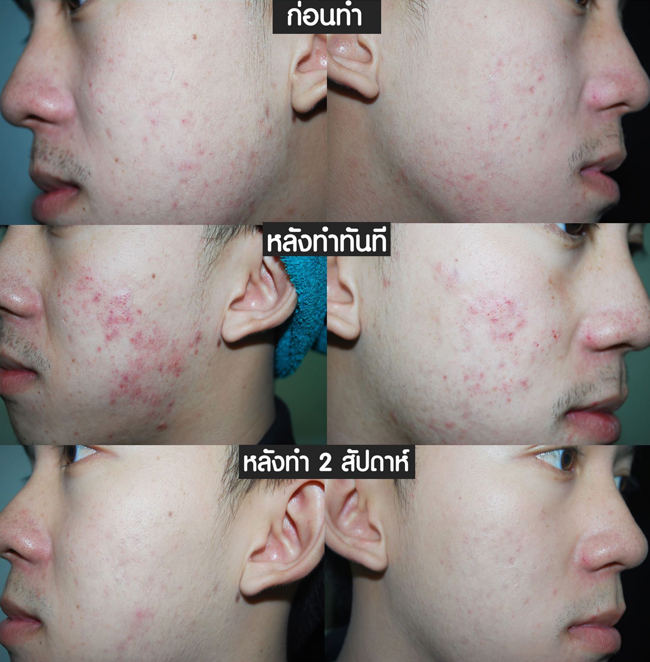 รีวิว เติมเต็มหลุมสิวด้วยฟิลเลอร์ (Skin Booster) คริสตัลคลินิก มหาสารคาม รีวิว เติมเต็มหลุมสิวด้วยฟิลเลอร์ (Skin Booster) คริสตัลคลินิก มหาสารคาม