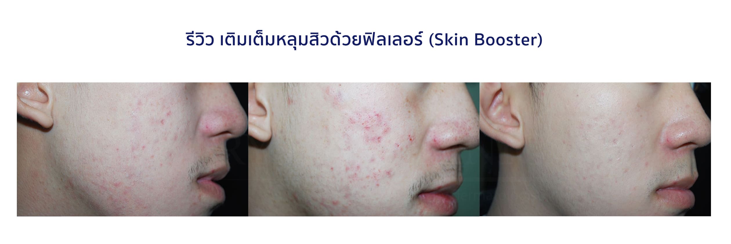 รีวิว เติมเต็มหลุมสิวด้วยฟิลเลอร์ (Skin Booster) คริสตัลคลินิก มหาสารคาม รีวิว เติมเต็มหลุมสิวด้วยฟิลเลอร์ (Skin Booster) คริสตัลคลินิก มหาสารคาม