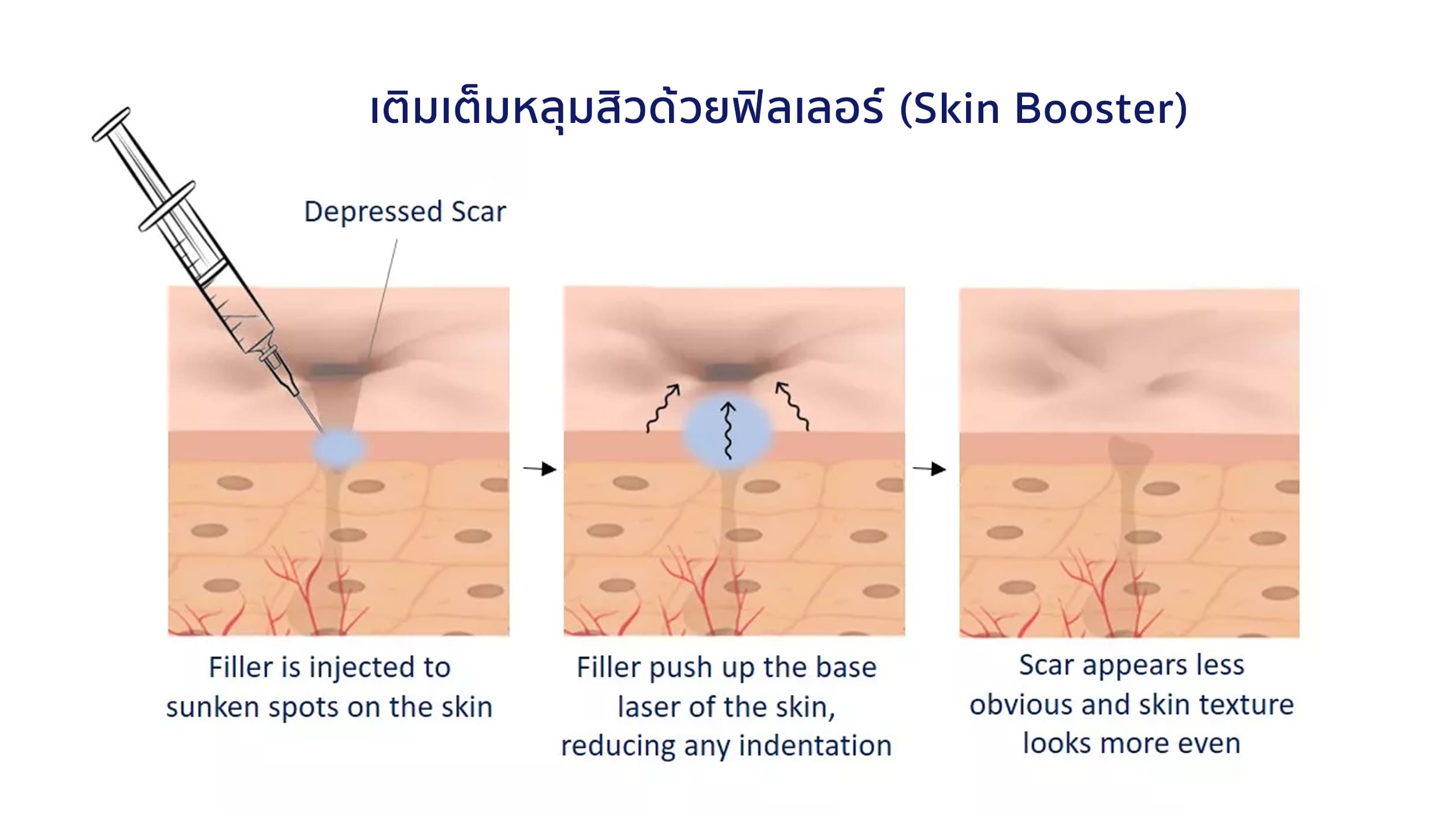 เติมเต็มหลุมสิวด้วยฟิลเลอร์ (Skin Booster) เติมเต็มหลุมสิวด้วยฟิลเลอร์ (Skin Booster)