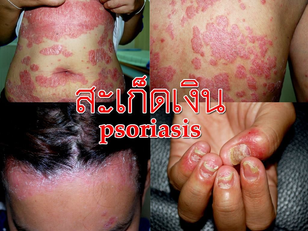 โรคสะเก็ดเงิน (psoriasis) โรคสะเก็ดเงิน (psoriasis)