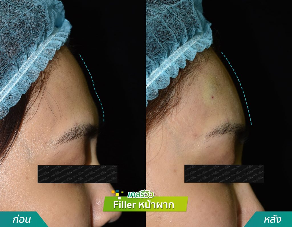 รีวิวเคส ฉีด Filler หน้าผาก คริสตัลคลินิก มหาสารคาม รีวิวเคส ฉีด Filler หน้าผาก คริสตัลคลินิก มหาสารคาม