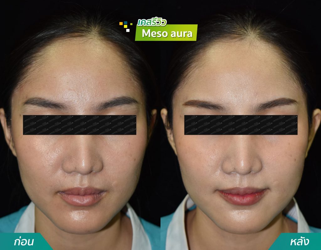 รีวิวฉีด Meeso aura คริสตัลคลินิก มหาสารคาม รีวิวฉีด Meeso aura คริสตัลคลินิก มหาสารคาม