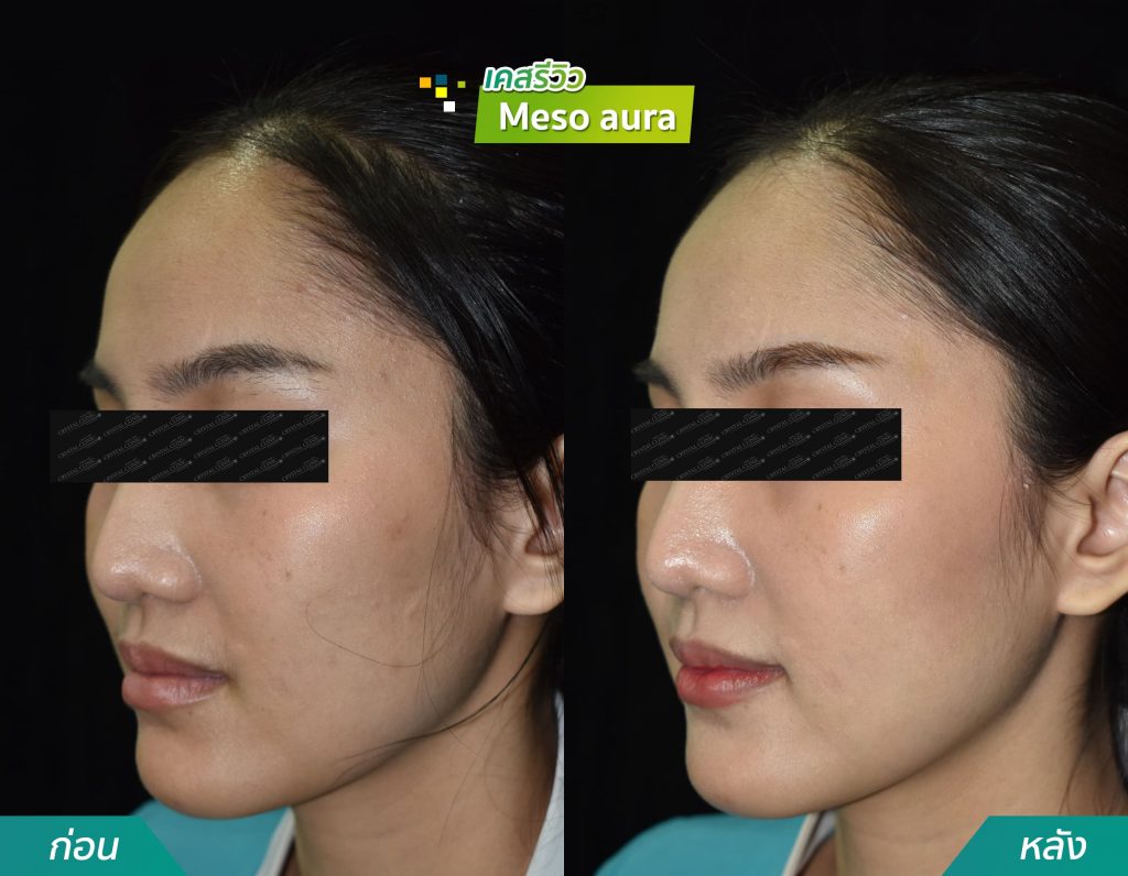 รีวิวฉีด Meeso aura คริสตัลคลินิก มหาสารคาม รีวิวฉีด Meeso aura คริสตัลคลินิก มหาสารคาม