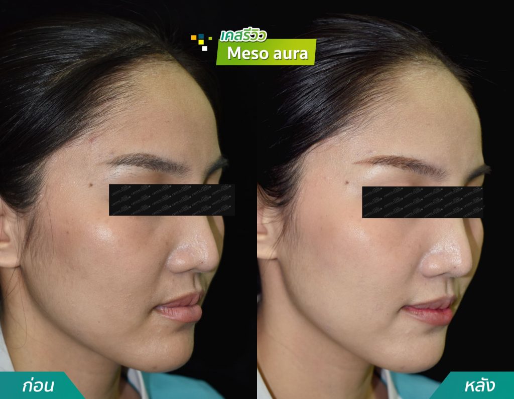 รีวิวฉีด Meeso aura คริสตัลคลินิก มหาสารคาม รีวิวฉีด Meeso aura คริสตัลคลินิก มหาสารคาม