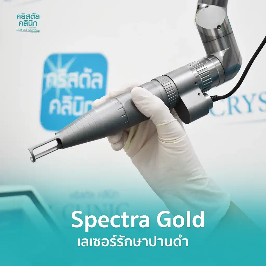 Spectra Gold Laser รักษาปานดำ คริสตัลคลินิก มหาสารคาม