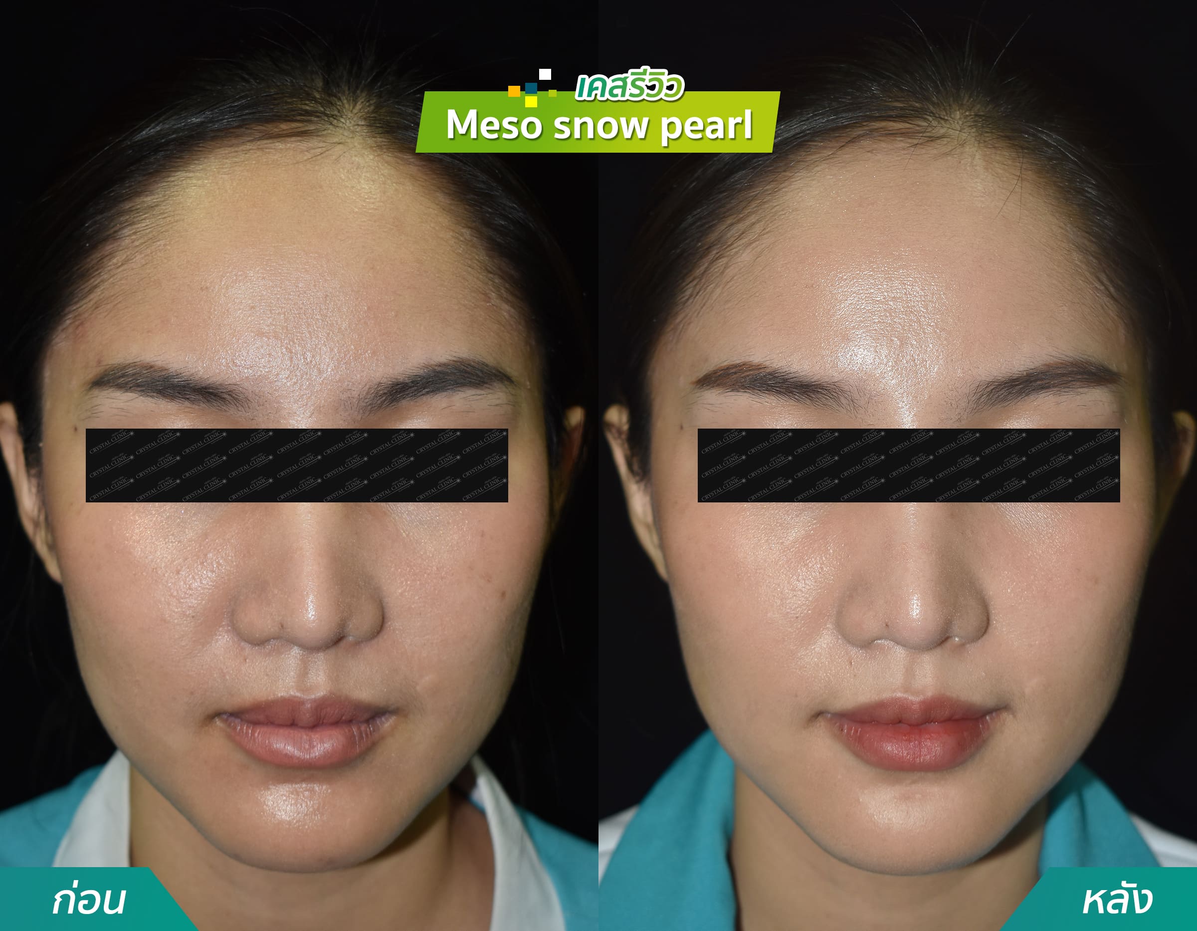 รีวิวฉีด meso snow pearl คริสตัลคลินิก มหาสารคาม รีวิวฉีด meso snow pearl คริสตัลคลินิก มหาสารคาม