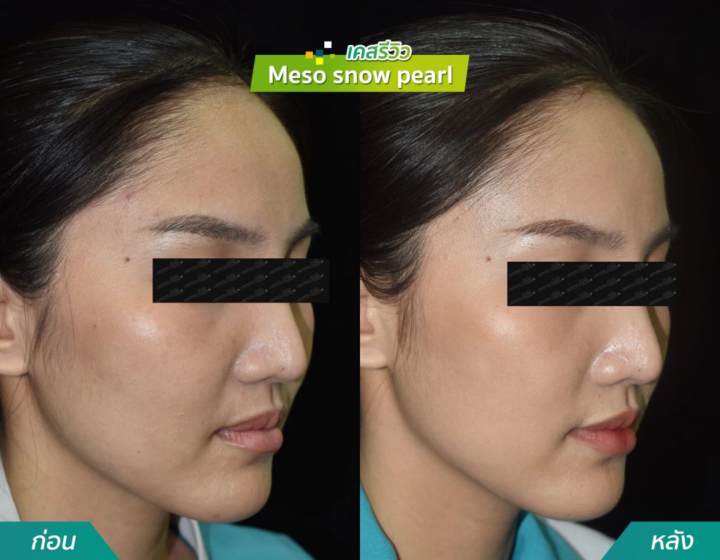 รีวิวฉีด meso snow pearl คริสตัลคลินิก มหาสารคาม รีวิวฉีด meso snow pearl คริสตัลคลินิก มหาสารคาม