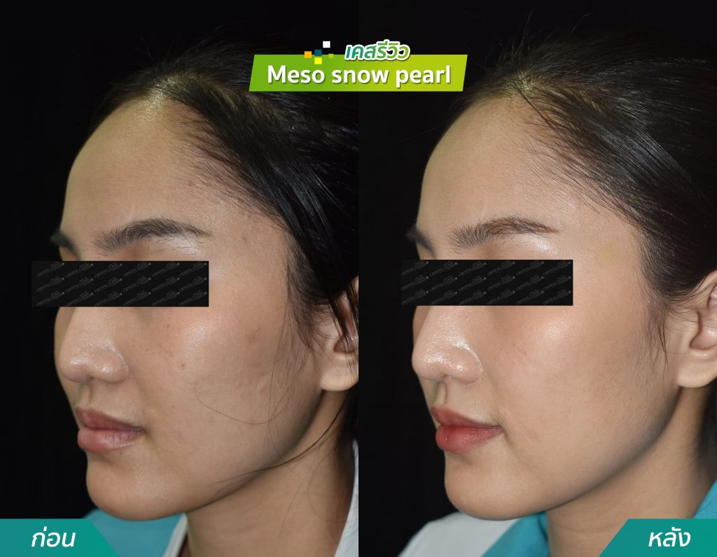 รีวิวฉีด meso snow pearl คริสตัลคลินิก มหาสารคาม รีวิวฉีด meso snow pearl คริสตัลคลินิก มหาสารคาม