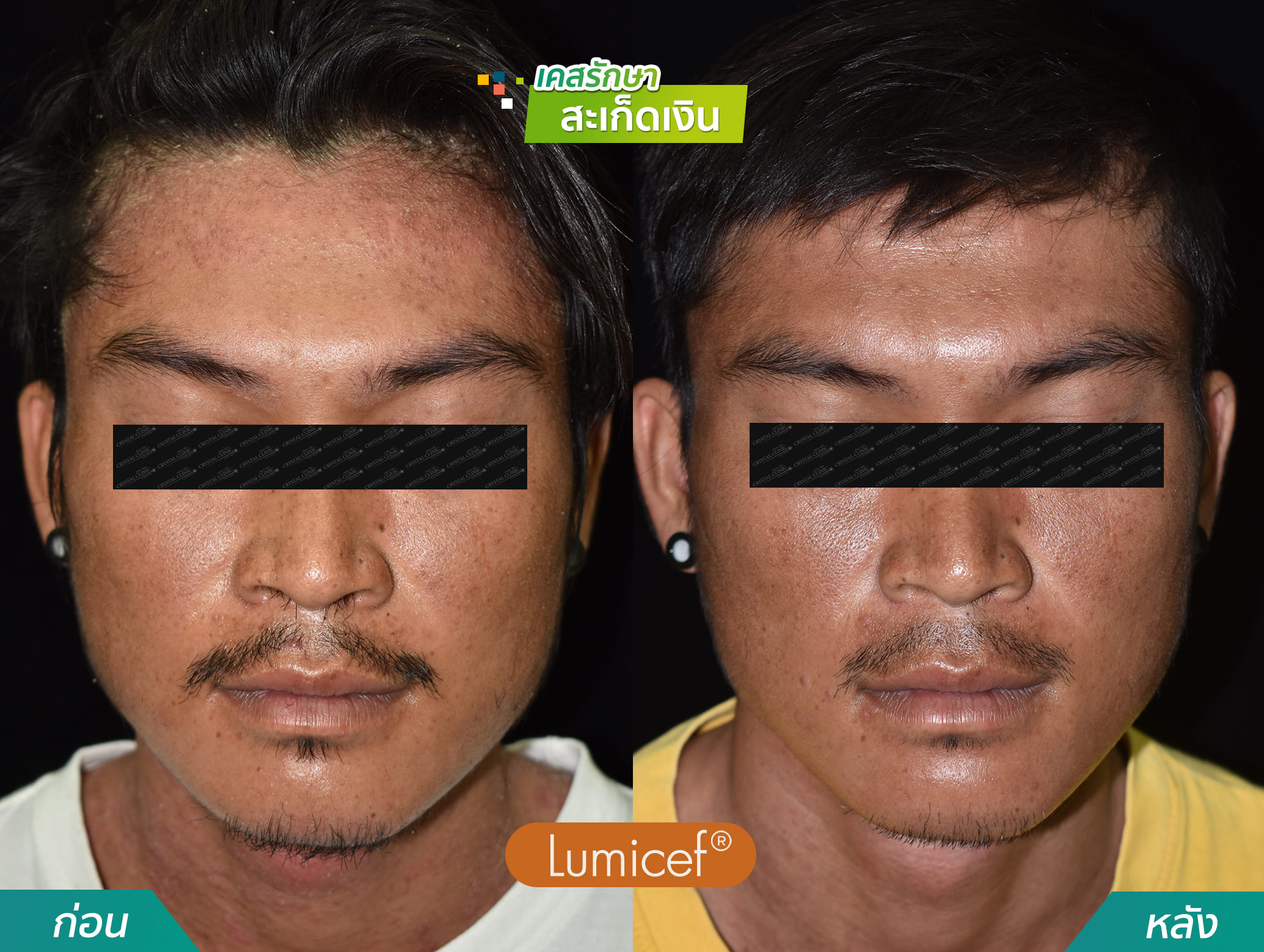 รีวิวฉีดยาชีวโมเลกุล รักษาโรคสะเก็ดเงิน - คริสตัลคลินิก มหาสารคาม