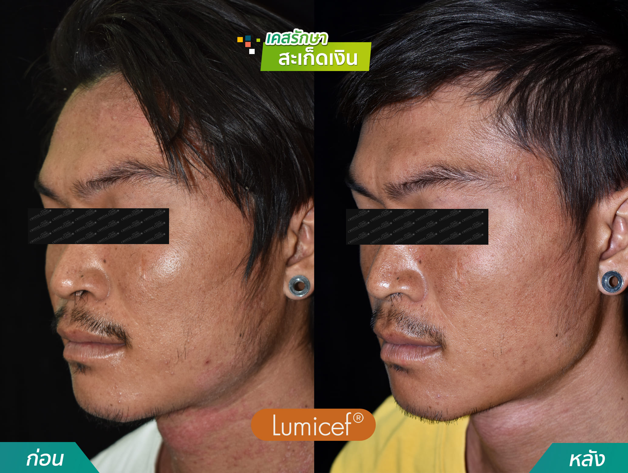 รีวิวฉีดยาชีวโมเลกุล รักษาโรคสะเก็ดเงิน - คริสตัลคลินิก มหาสารคาม