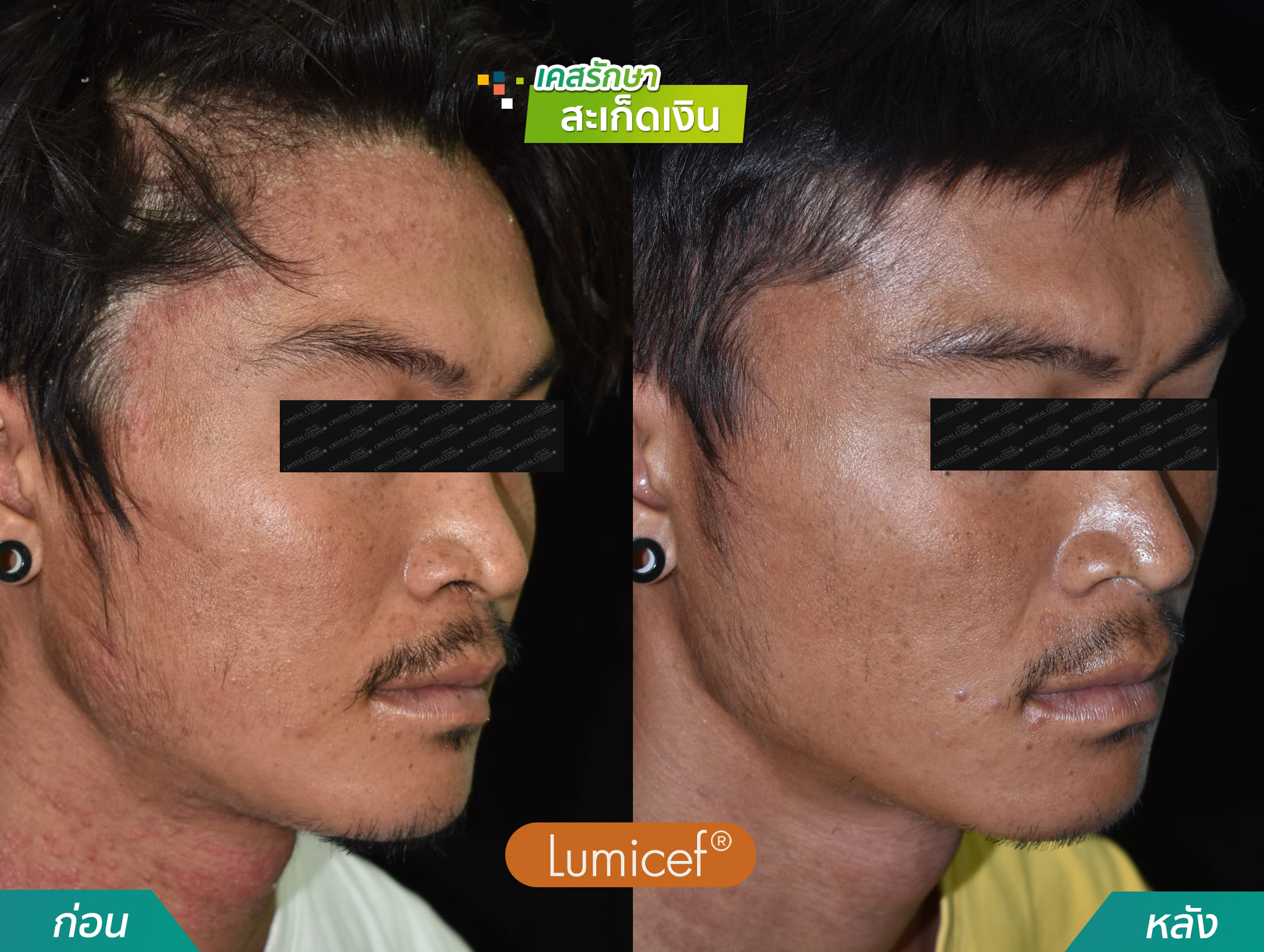 รีวิวฉีดยาชีวโมเลกุล รักษาโรคสะเก็ดเงิน - คริสตัลคลินิก มหาสารคาม