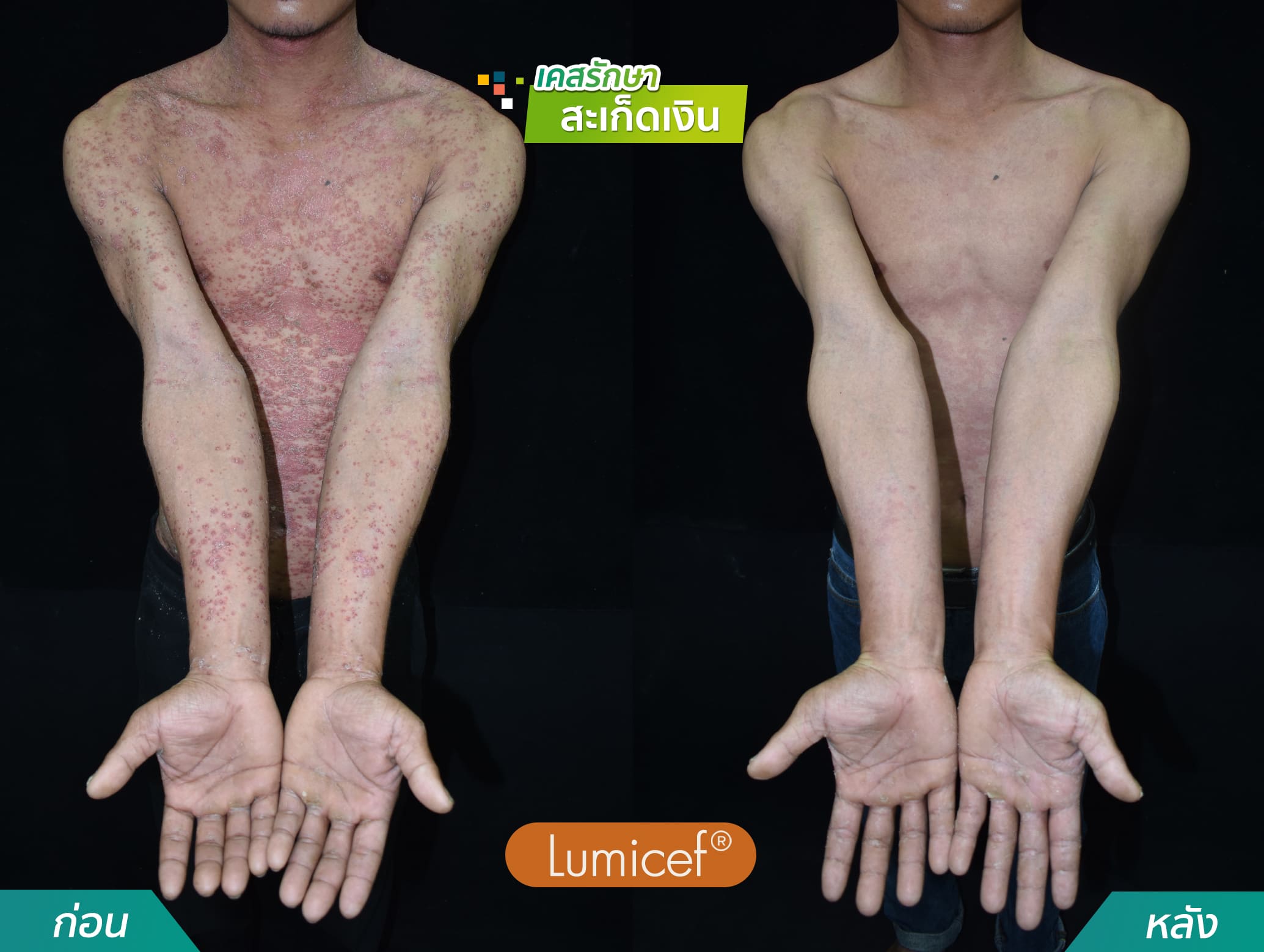 รีวิวฉีดยาชีวโมเลกุล รักษาโรคสะเก็ดเงิน - คริสตัลคลินิก มหาสารคาม