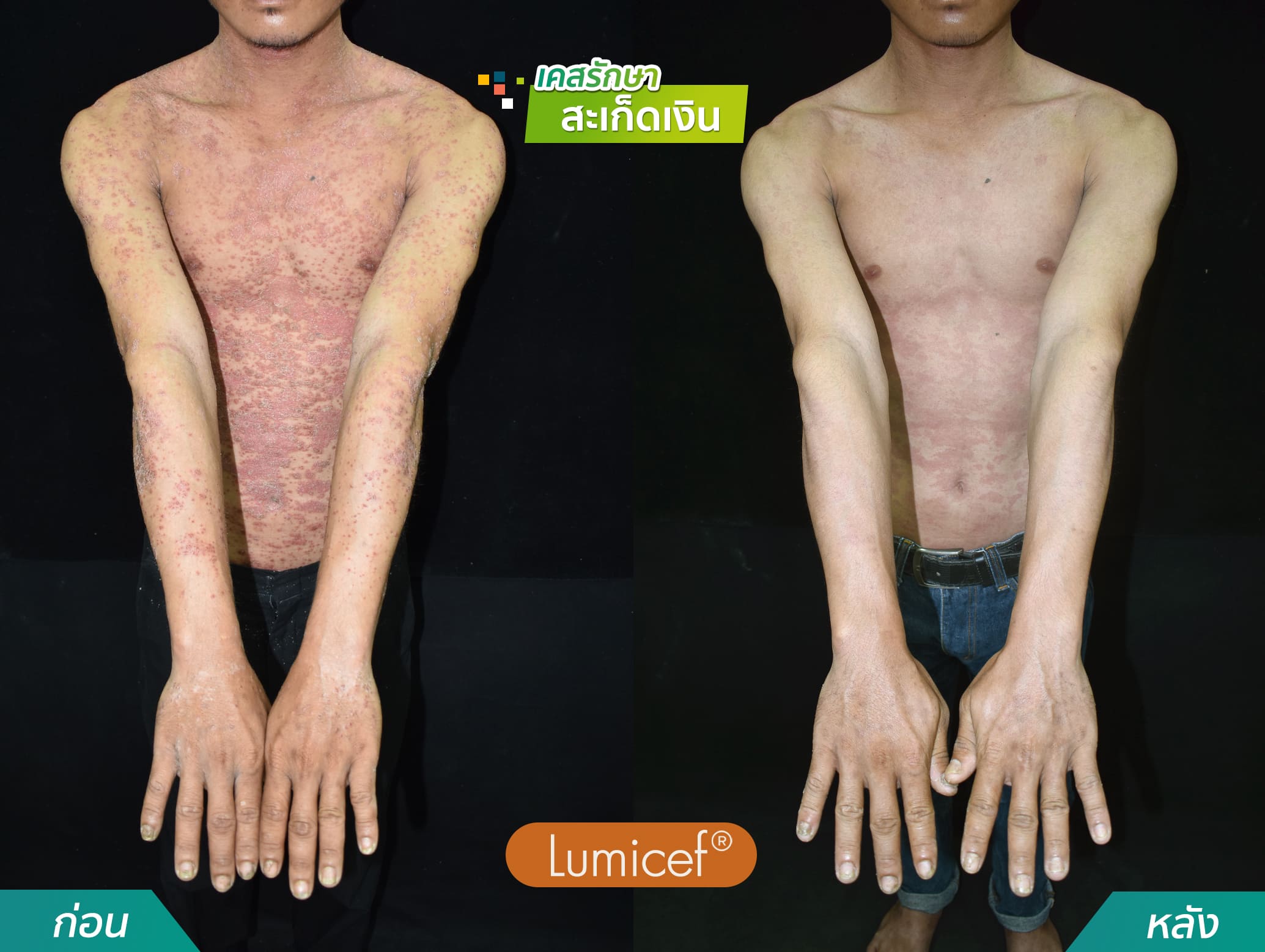 รีวิวฉีดยาชีวโมเลกุล รักษาโรคสะเก็ดเงิน - คริสตัลคลินิก มหาสารคาม