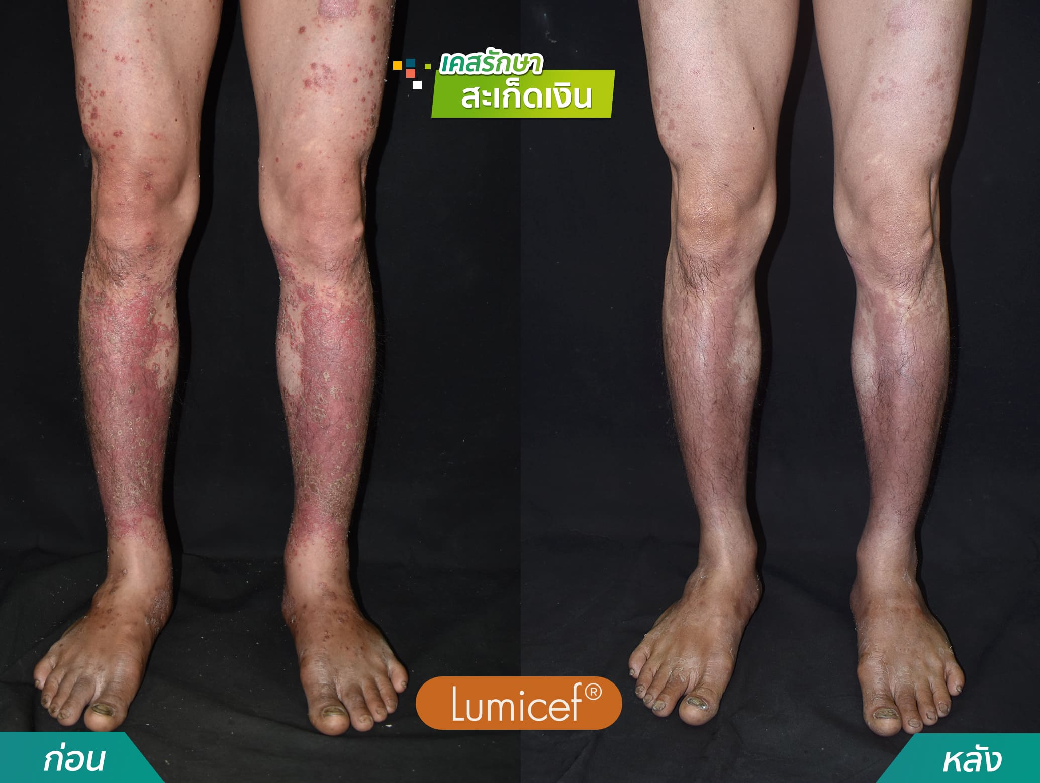 รีวิวฉีดยาชีวโมเลกุล รักษาโรคสะเก็ดเงิน - คริสตัลคลินิก มหาสารคาม