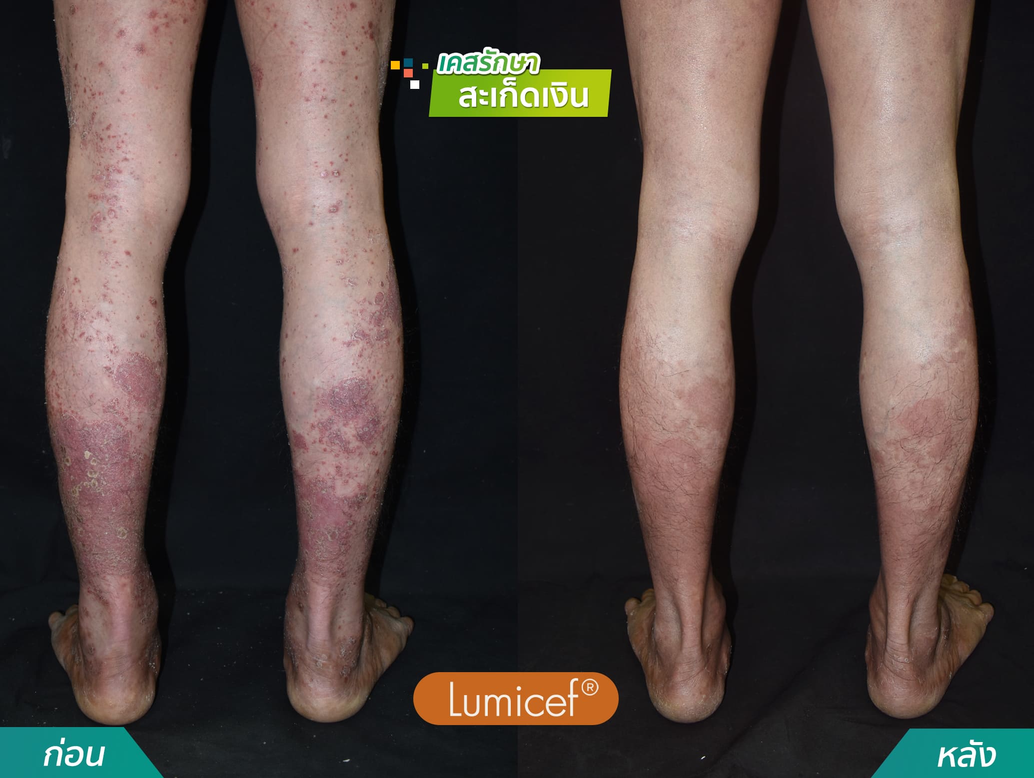 รีวิวฉีดยาชีวโมเลกุล รักษาโรคสะเก็ดเงิน - คริสตัลคลินิก มหาสารคาม 07