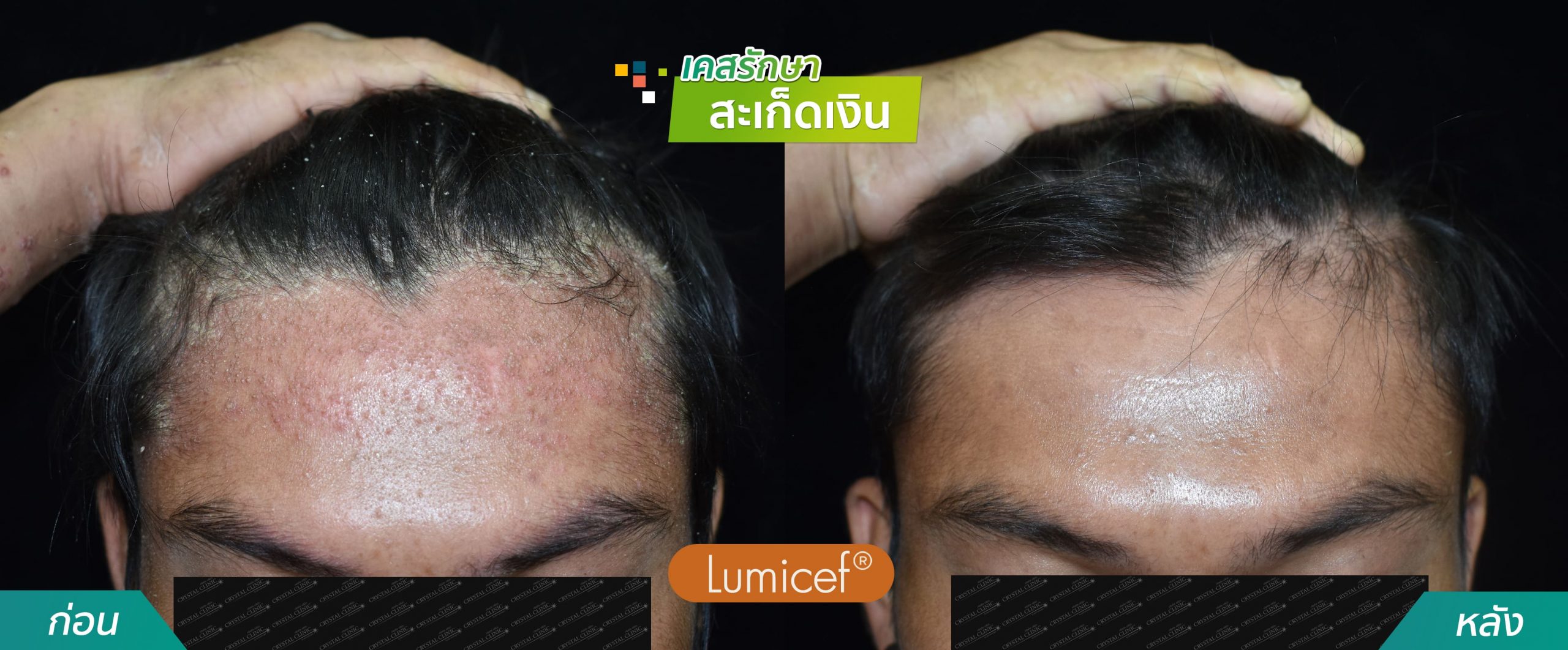 รีวิวฉีดยาชีวโมเลกุล รักษาโรคสะเก็ดเงิน - คริสตัลคลินิก มหาสารคาม