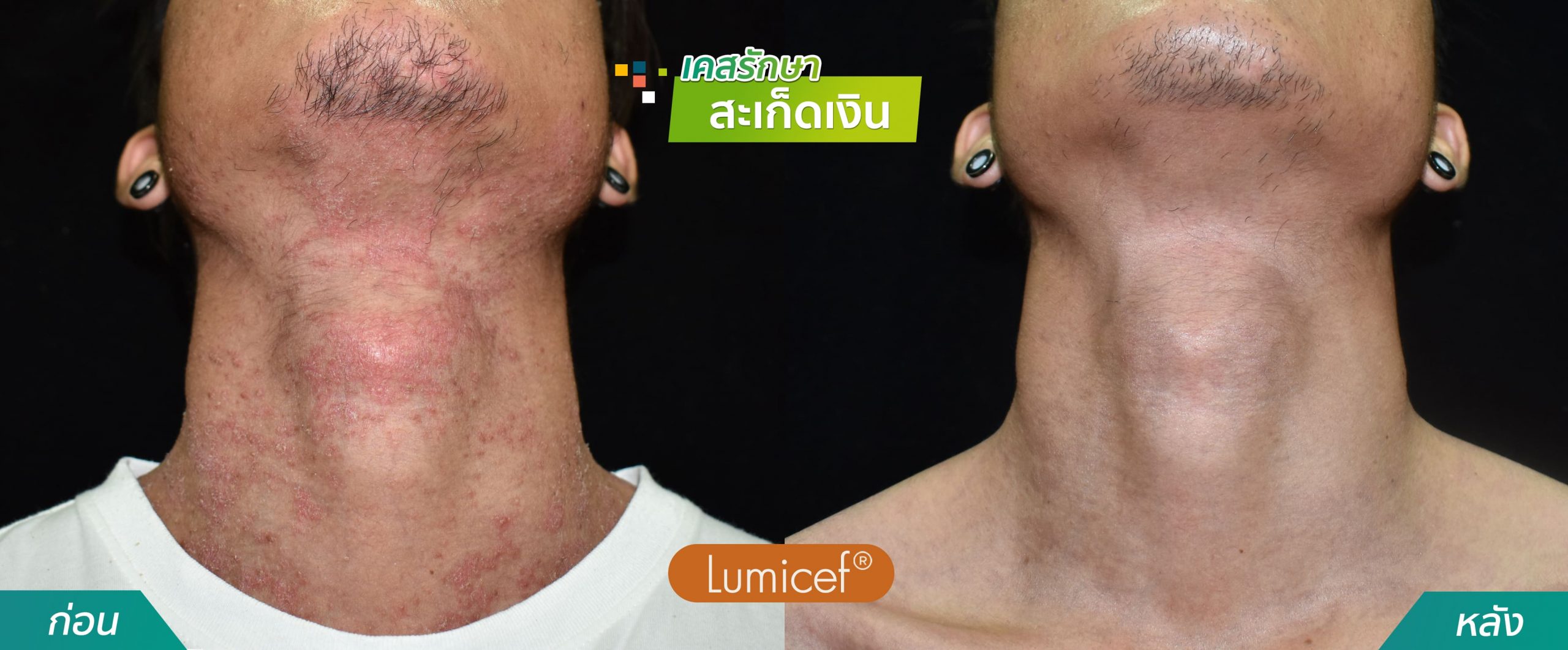 รีวิวฉีดยาชีวโมเลกุล รักษาโรคสะเก็ดเงิน - คริสตัลคลินิก มหาสารคาม