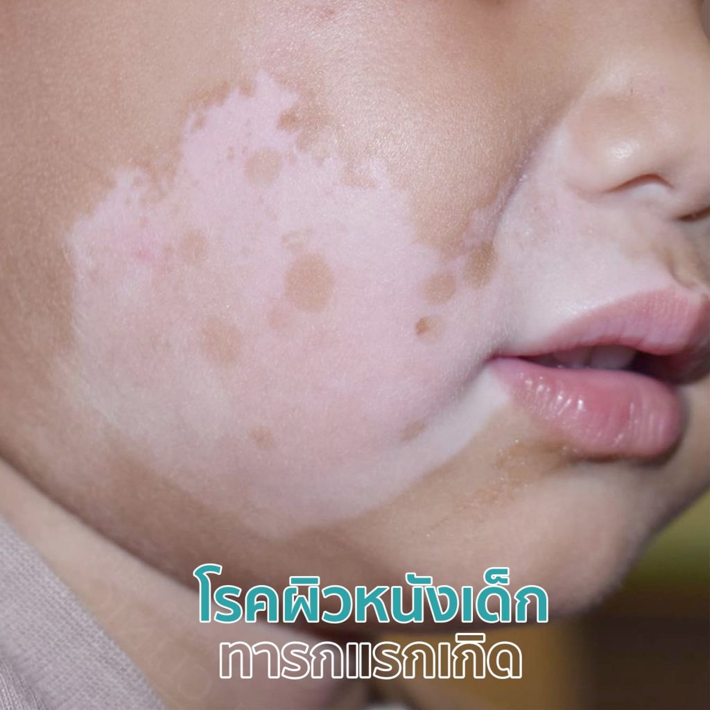 โรคผิวหนังเด็ก ทารกแรกเกิด - คริสตัลคลินิก มหาสารคาม